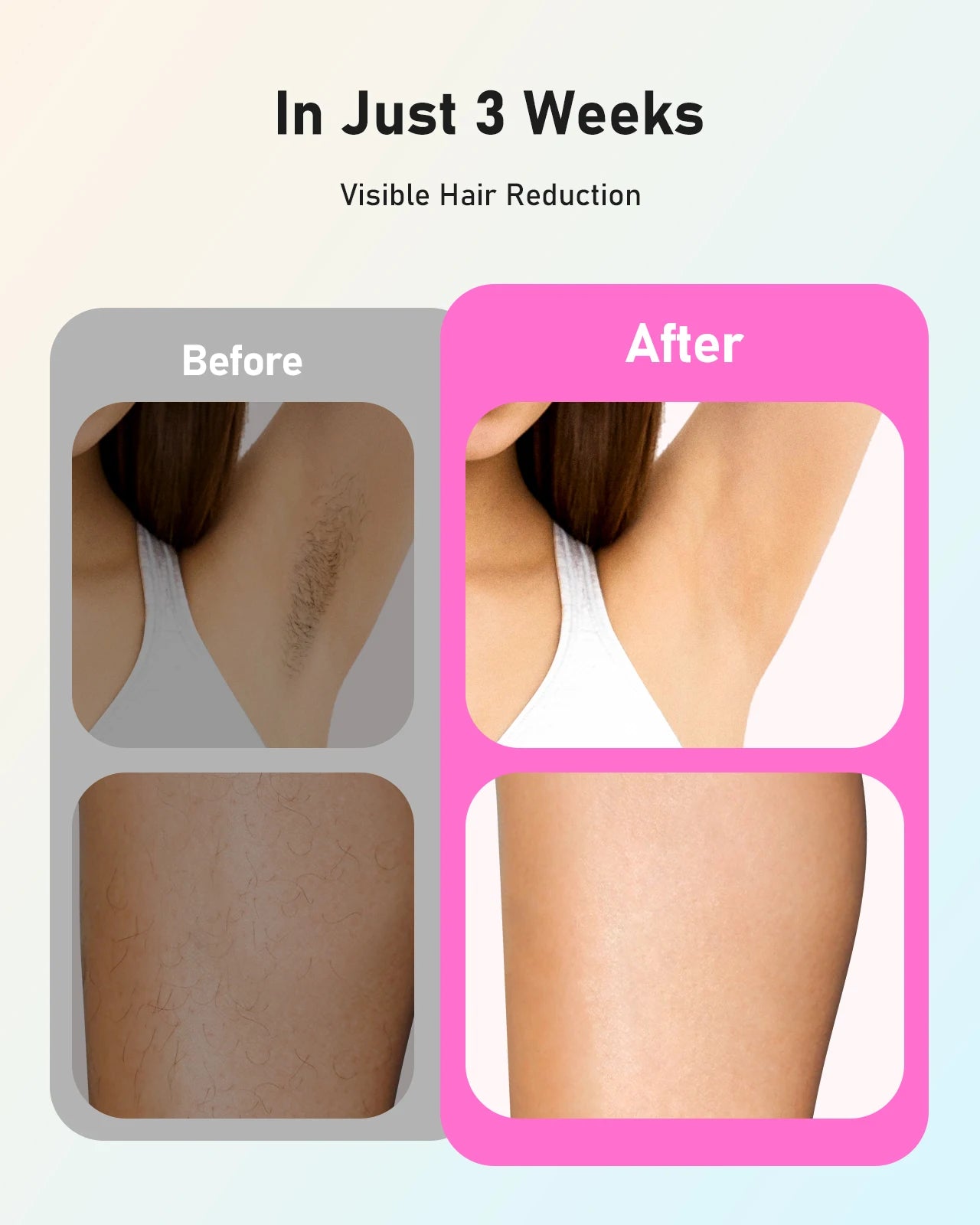 990,000 Flash Laser Hair Removal - Painless Cooling Permanent IPL for Women & Men Body, Bikini & Facial Areas