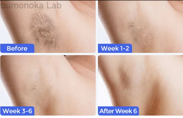 IPL Hair Removal Device - 999,999 Flashes Permanent Hair Removal Full Body Treatment